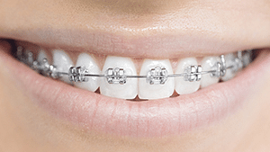 Braces Waterville Auburn Lewiston ME | Smiles For Maine Orthodontics